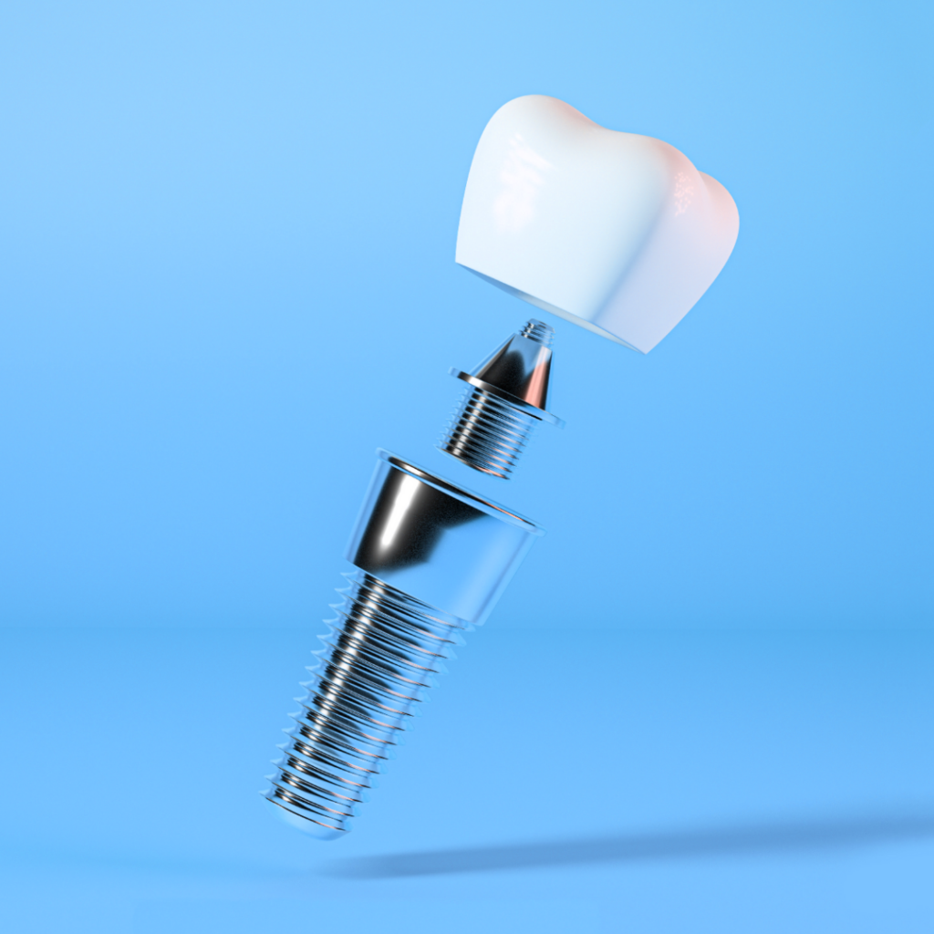 implantes-dentales-murcia